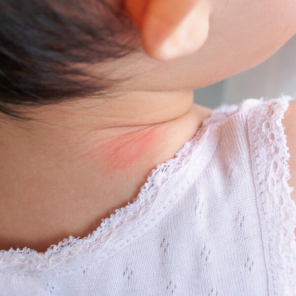 Everything You Need To Know About Eczema