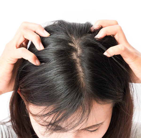 What To Know About Treating An Itchy Scalp